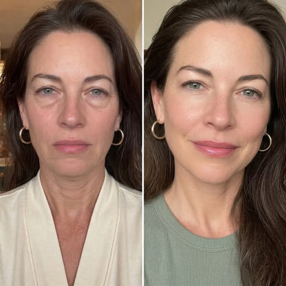 Striche Skin Lift™