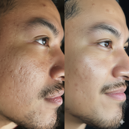 Striche Skin Lift™