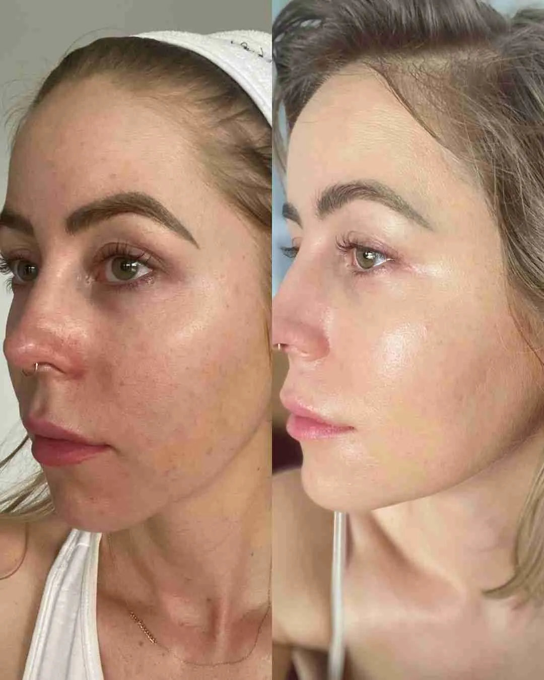 Striche Skin Lift™
