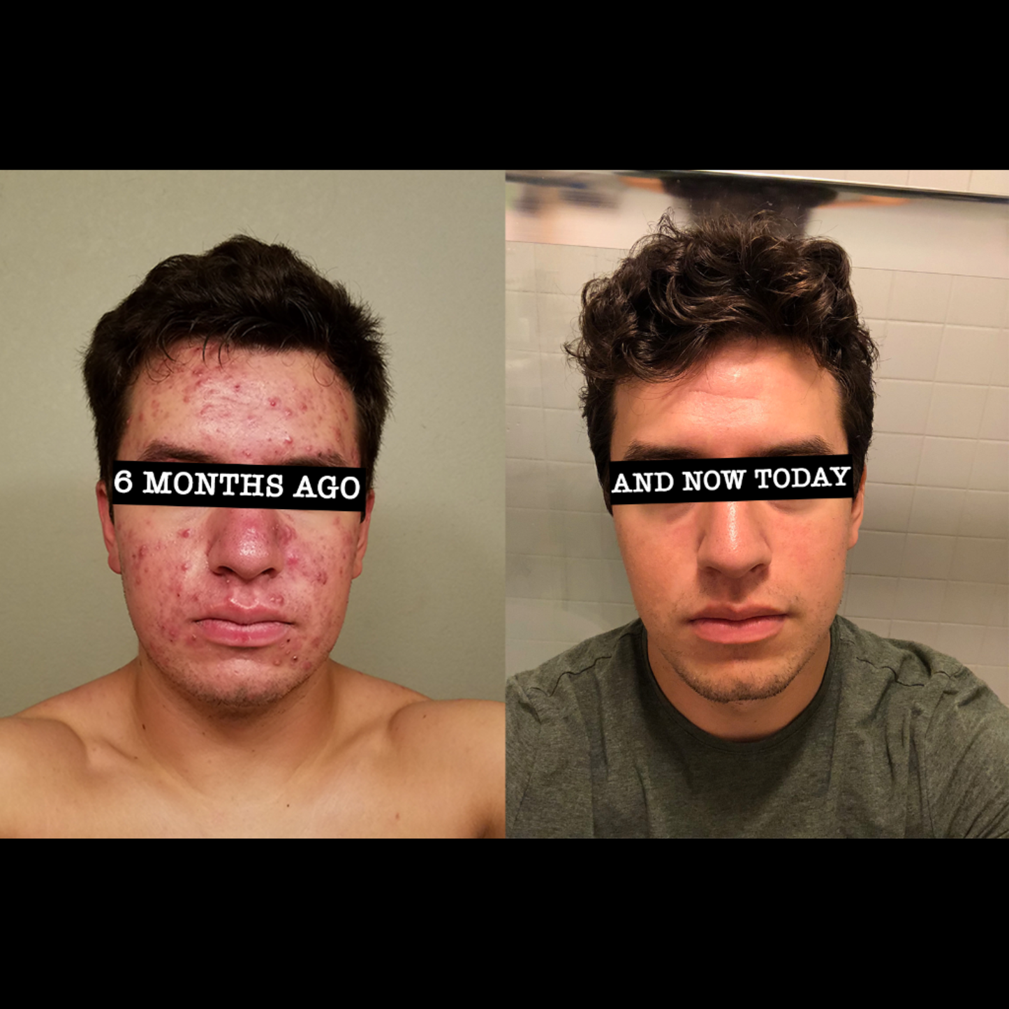 Striche Skin Lift™